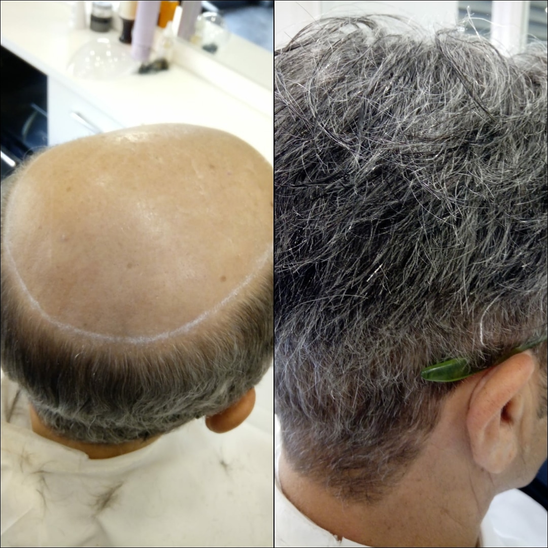protesi capelli torino