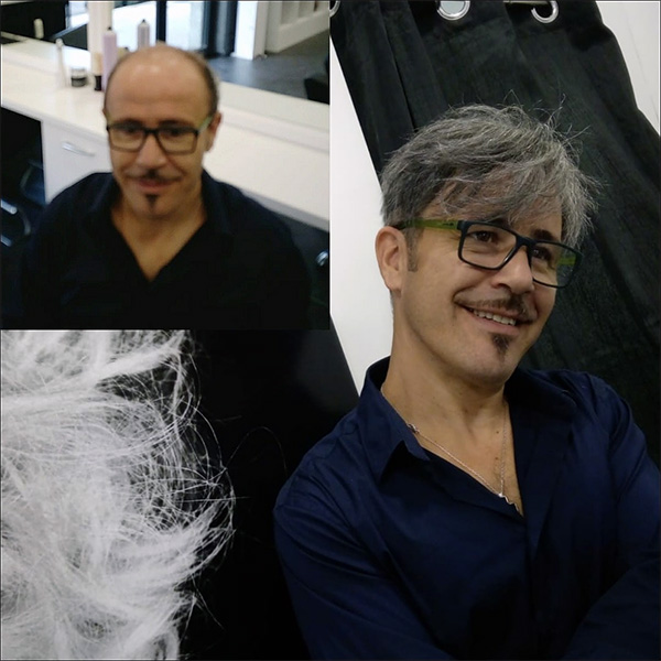 Protesi Capelli Torino esempio